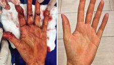 След нарязани нерви и сухожилия: Тази ръка посяга към титлата в Ню Йорк! + СНИМКА (18+)