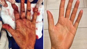 След нарязани нерви и сухожилия: Тази ръка посяга към титлата в Ню Йорк! + СНИМКА (18+)
